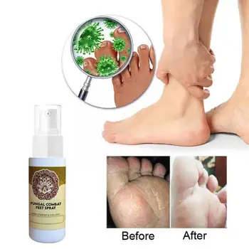 Seente Võidelda Feet Spray Anti seeninfektsiooni Sportlane Bakterite Villid Erosiooni Anti Beriberi Asjade Spray Koorimine Sügelema S4L9